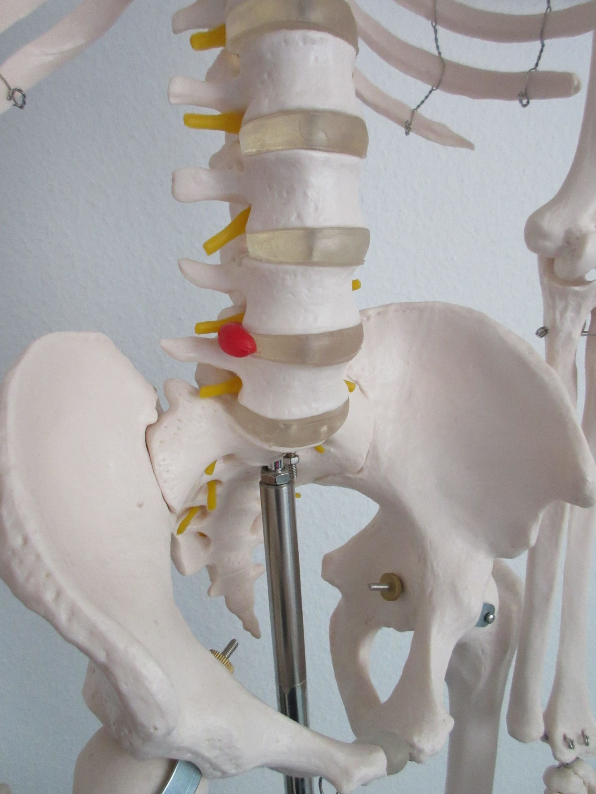 Ein Bandscheibenvorfall kann Rückenschmerzen verursachen