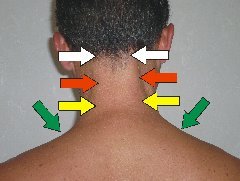 Verspannte Nackenmuskeln, besonders der kurzen Nackenmuskeln, können zu Kopfschmerzen führen 