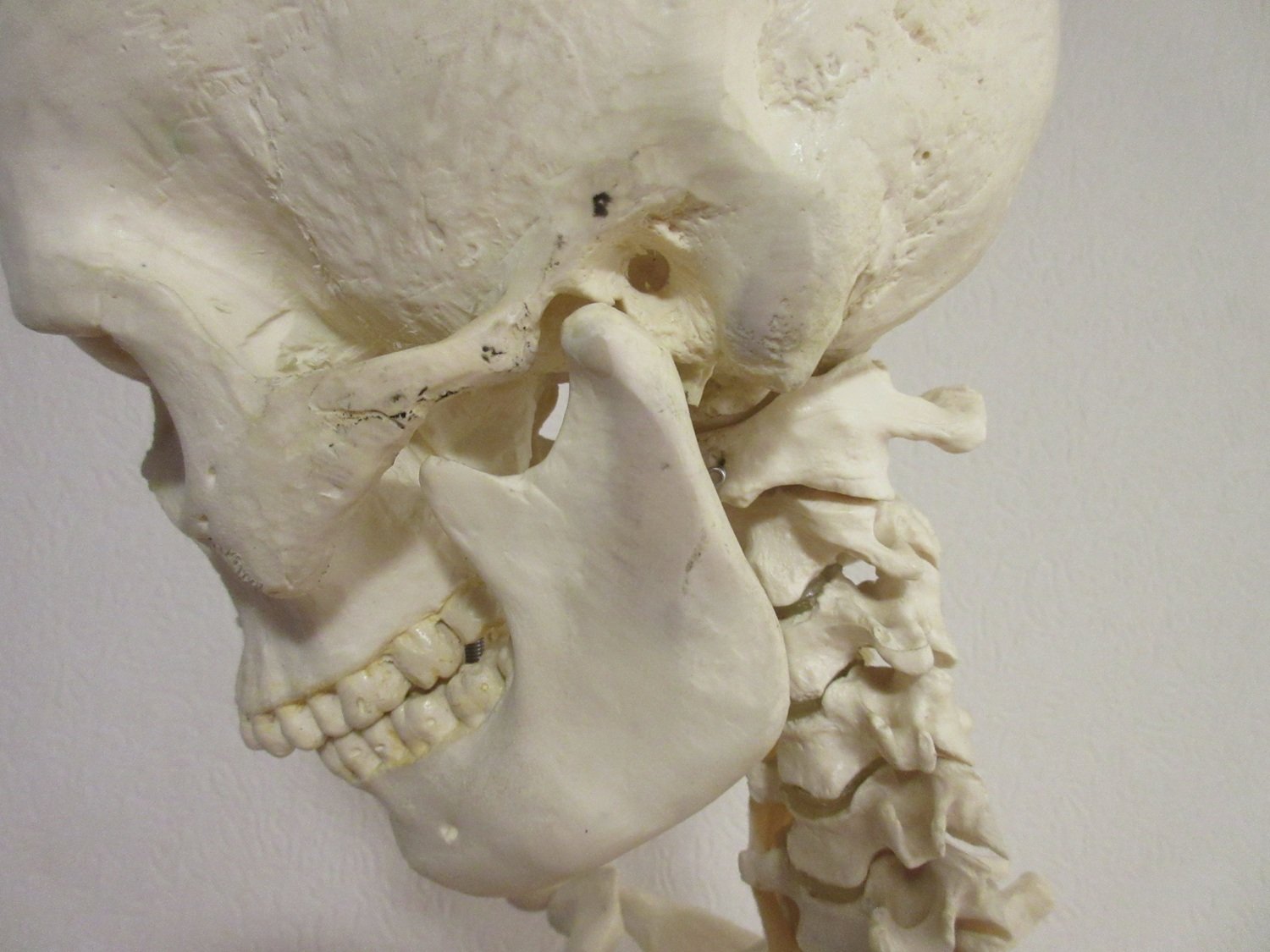 Craniomandibuläre Dysfunktion