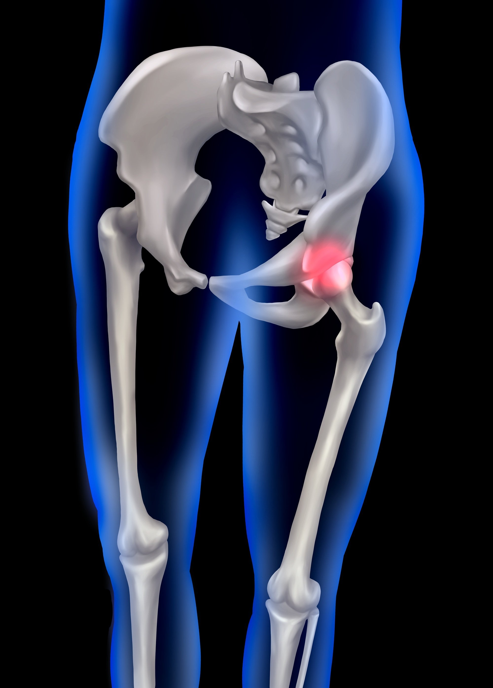 Hüftgelenke sind besonders häufig von Arthrose betroffen