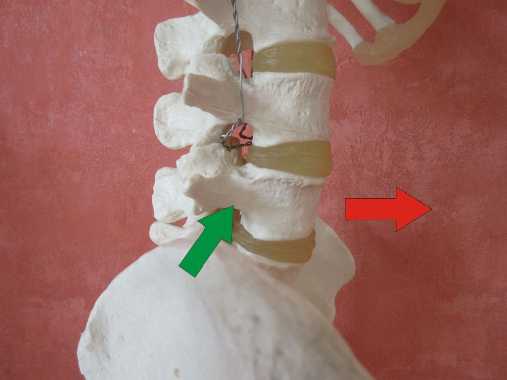 Gleitwirbel – Wirbelgleiten. Abrutschen eines Lendenwirbels nach vorn. Osteopathie kann helfen