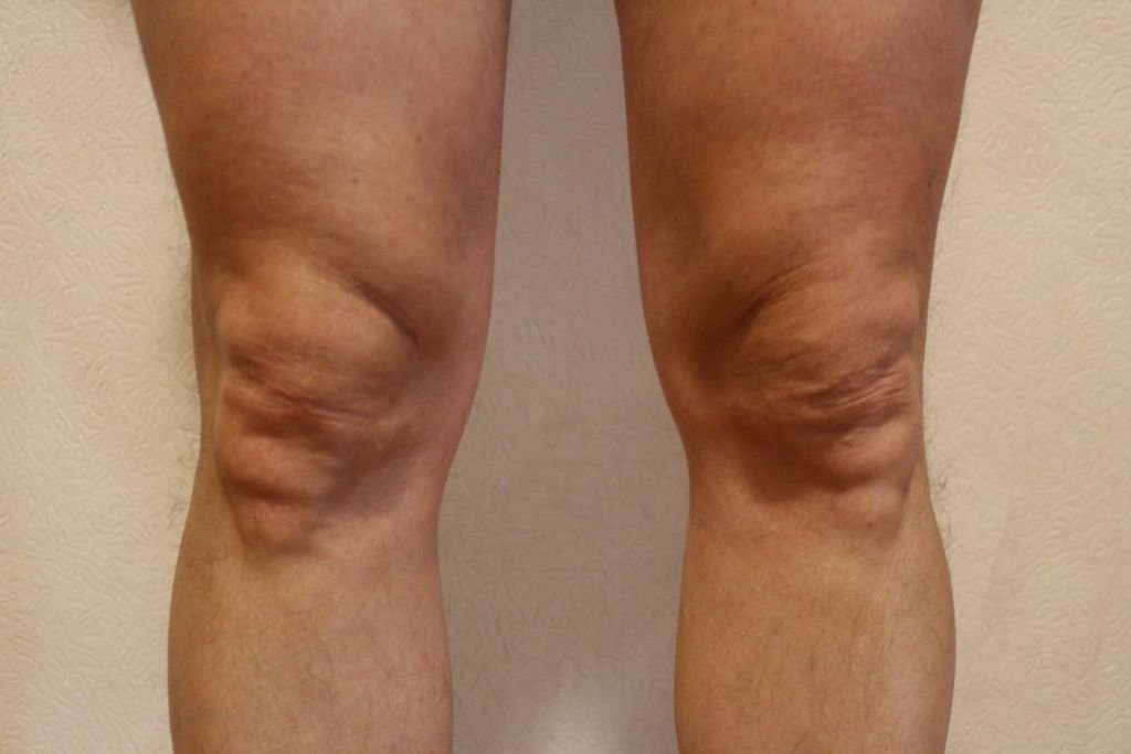 Die Kniegelenke sind häufig von einem Knorpelschaden betroffen 